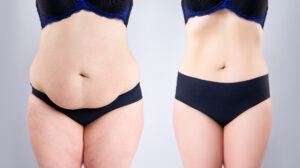 Tummy tuck and new abs in Folsom, CA