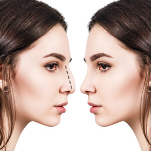 Rhinoplasty candidacy in Folsom, CA